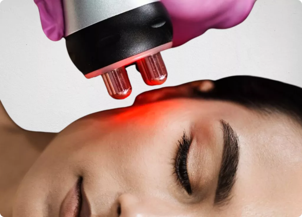 Radiofrecuencia facial para producción de colágeno