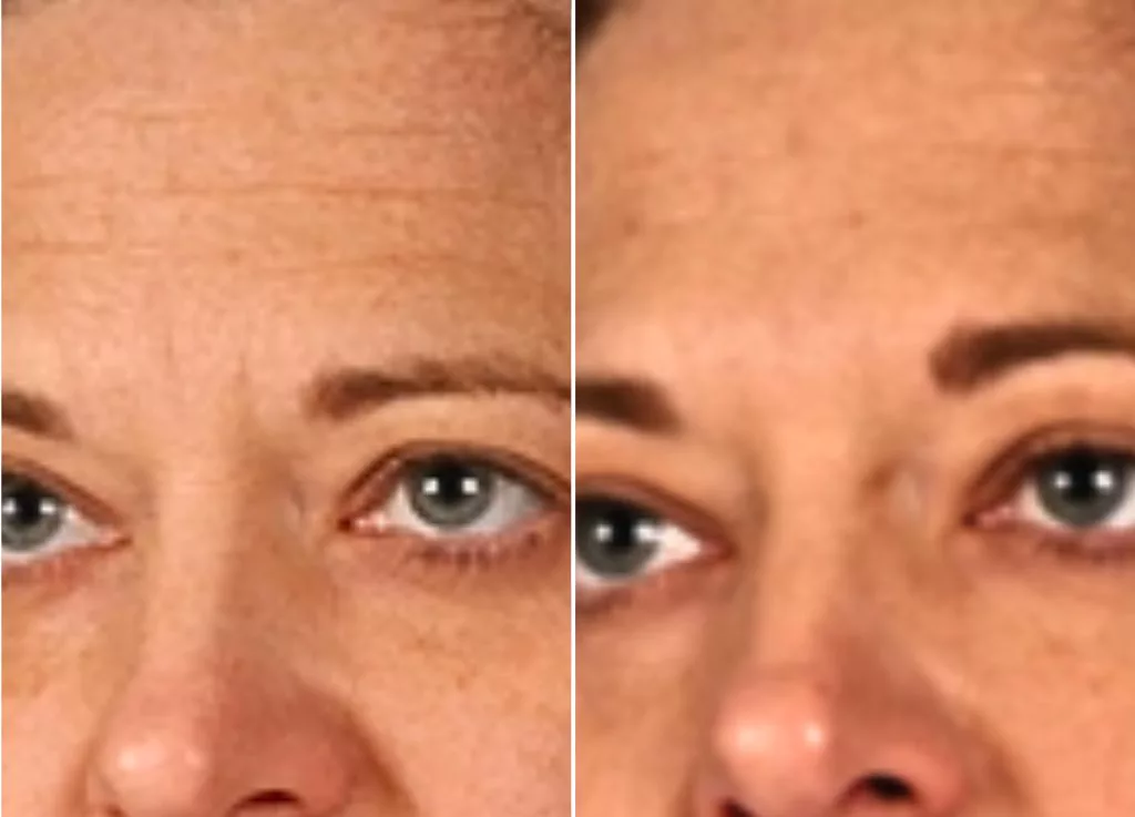Tratamiento radiofrecuencia Face Lifting Aura Skin