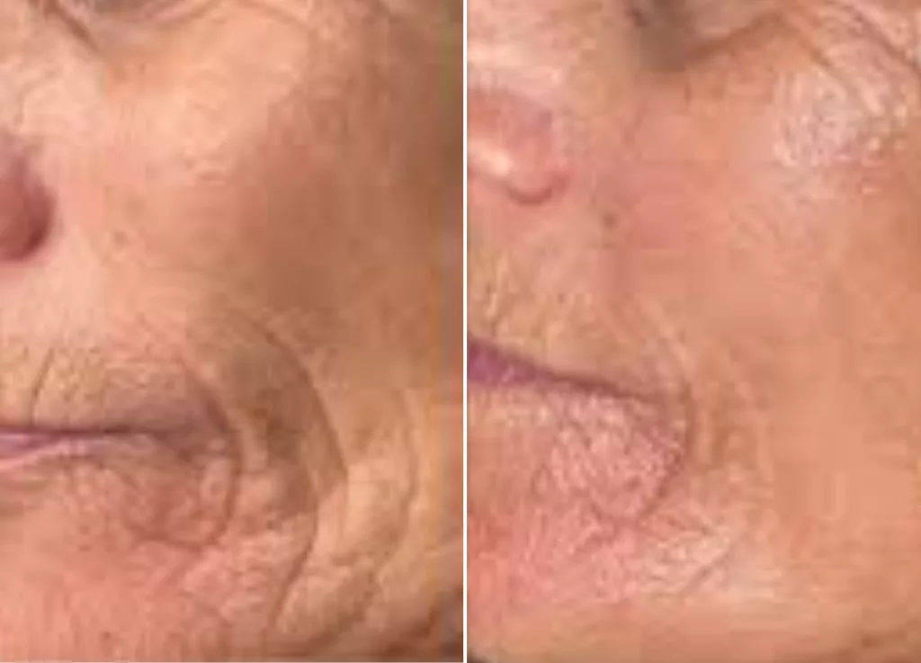 Tratamiento radiofrecuencia Flash Antiaging Aura Skin