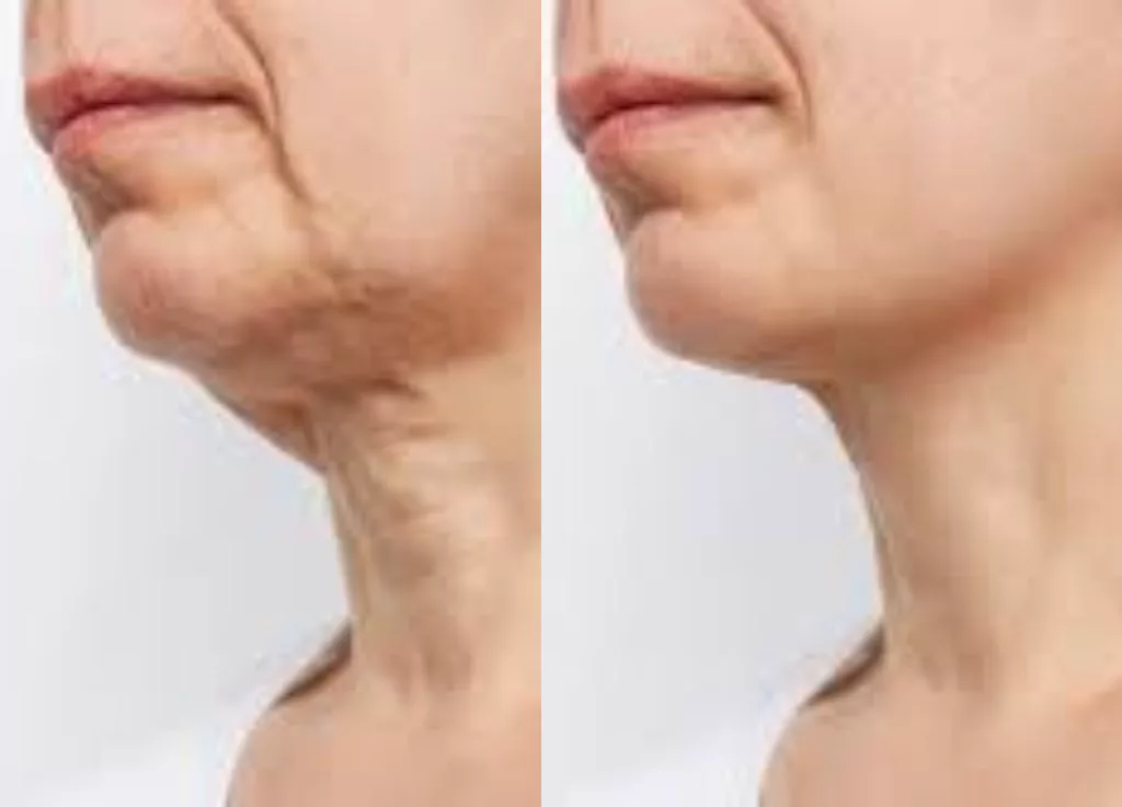 Tratamiento radiofrecuencia Neck Glow Aura Skin