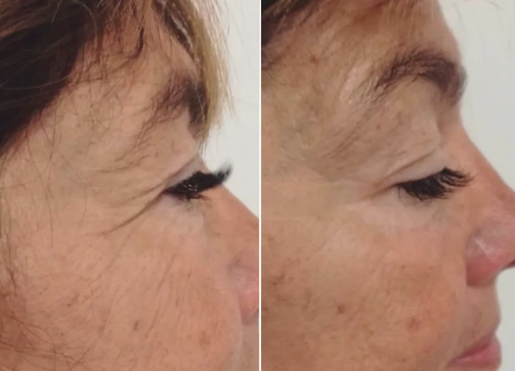 Tratamiento radiofrecuencia New Eyes Aura Skin